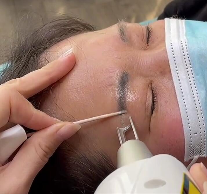 Hvad skal vi være opmærksomme på før og efter laser øjenbryn tatoveringsfjernelse?