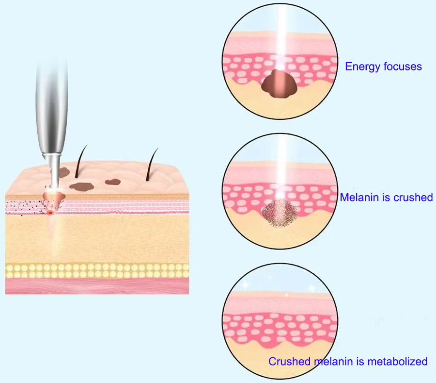 hyperpigmentation treatment laser